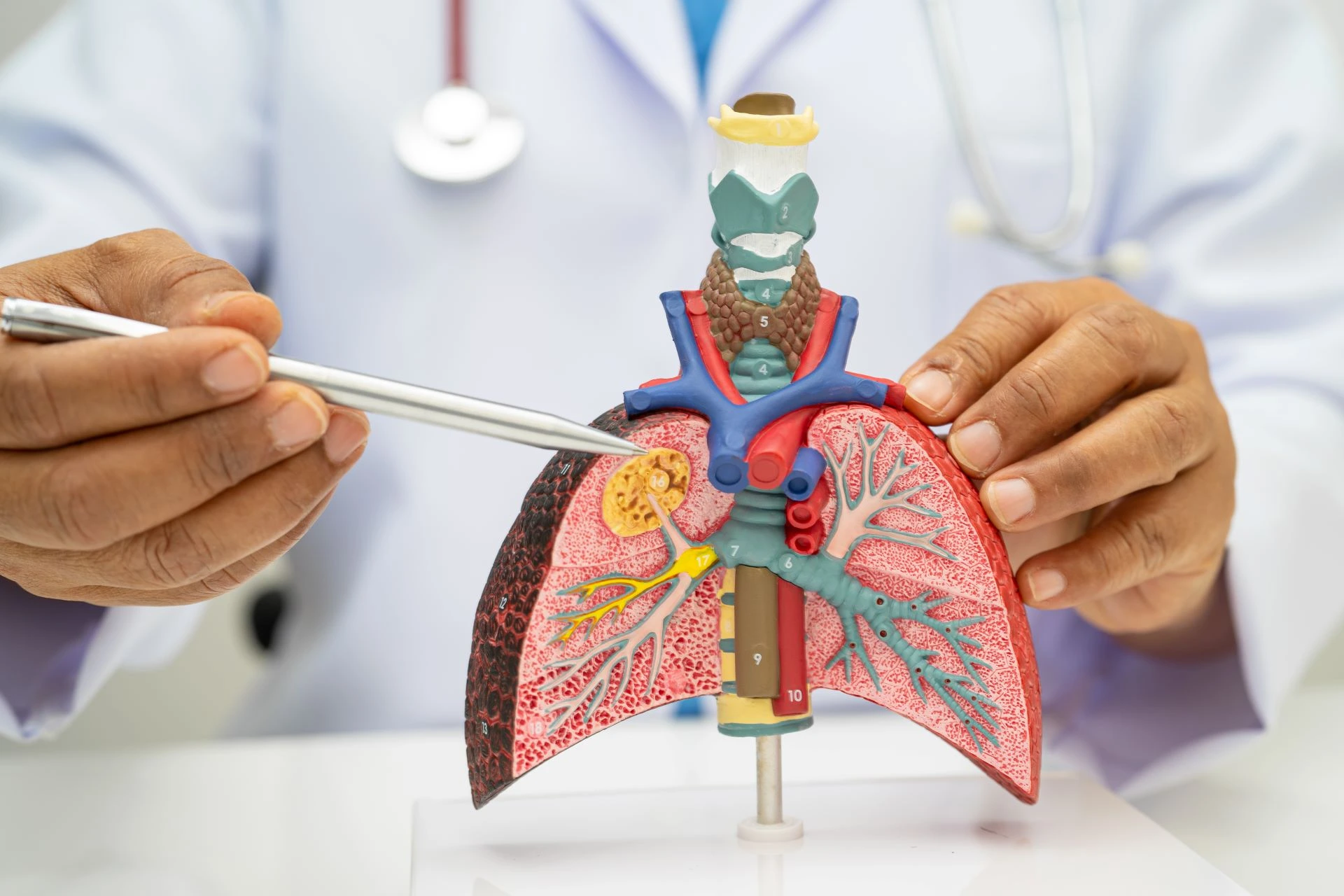 What is Lung Cancer? Understanding the Basics