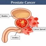 પ્રોસ્ટેટ કેન્સર