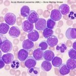 Acute Myeloid Leukemia