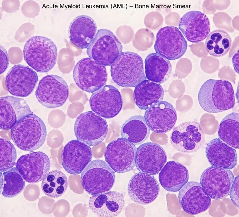 Acute Myeloid Leukemia
