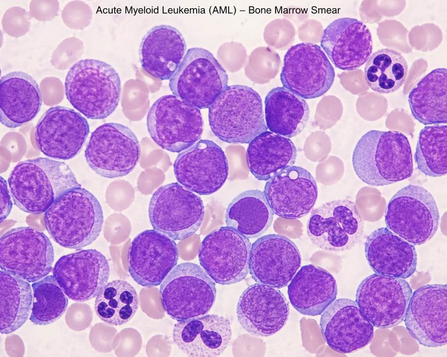 Acute Myeloid Leukemia
