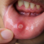 Mouth Ulcers Treatment
