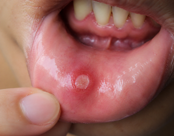 Mouth Ulcers Treatment