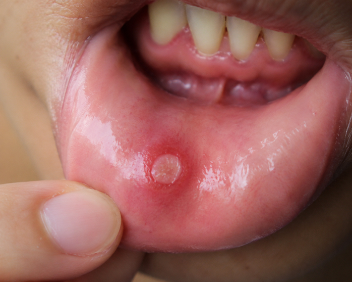 Mouth Ulcers Treatment