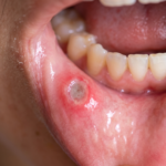 mouth ulcers treatment