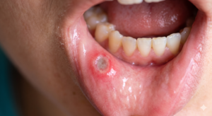mouth ulcers treatment