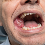 Best Ayurvedic Treatment for Mouth Cancer