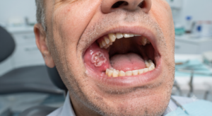 Best Ayurvedic Treatment for Mouth Cancer