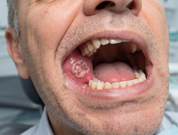 Best Ayurvedic Treatment for Mouth Cancer