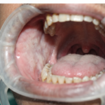 Oral Submucous Fibrosis