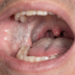 Oral Submucous Fibrosis