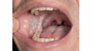 Oral Submucous Fibrosis