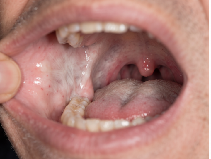 Oral Submucous Fibrosis