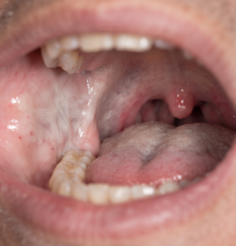 Oral Submucous Fibrosis