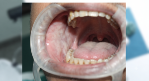 Oral Submucous Fibrosis