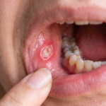 moulth ulcers treatment