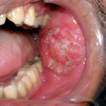 Oral Cancer Treatment