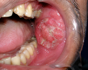 Oral Cancer Treatment