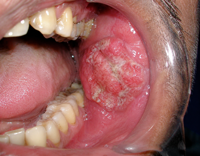 Oral Cancer Treatment