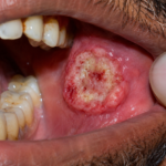 mouth cancer treatment in Mumbai