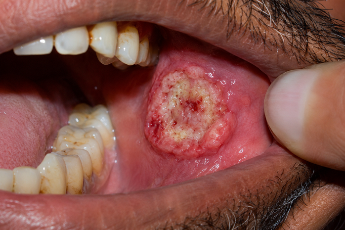 mouth cancer treatment in Mumbai