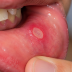 mouth ulcers treatment