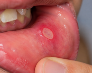 mouth ulcers treatment