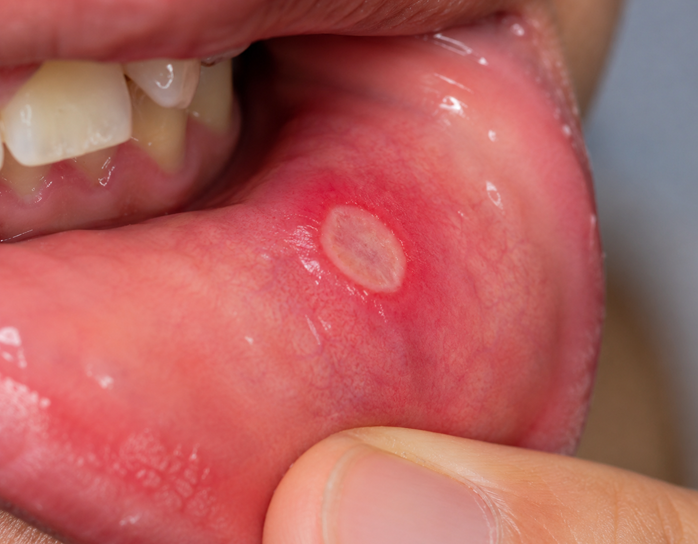 mouth ulcers treatment