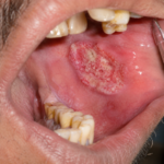 oral cancer treatment