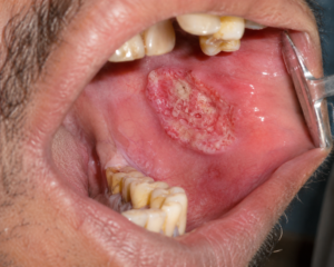 oral cancer treatment