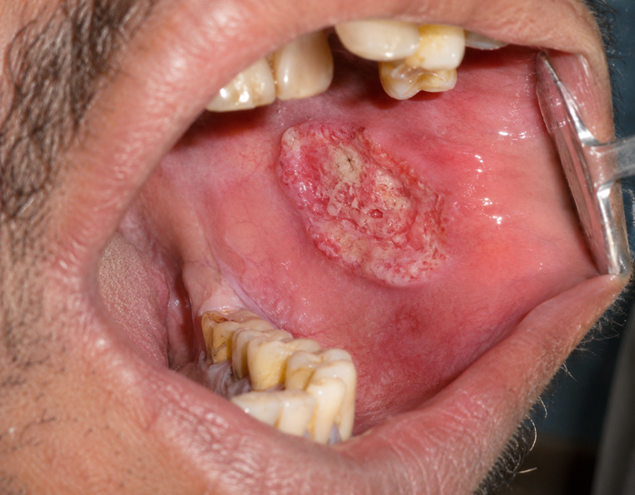 oral cancer treatment