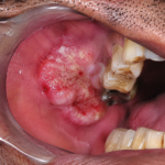 oral cancer treatment