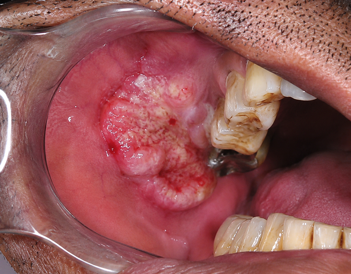 oral cancer treatment