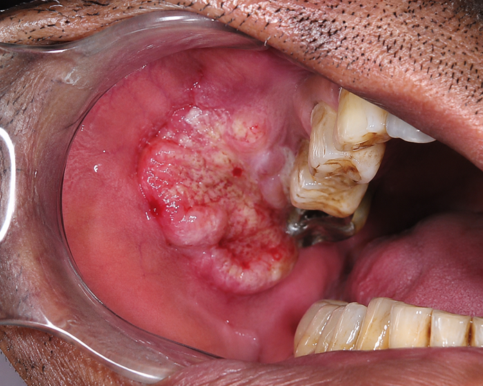 oral cancer treatment