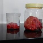 Breast Cancer Treatment