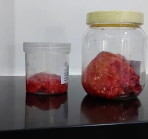 Breast Cancer Treatment