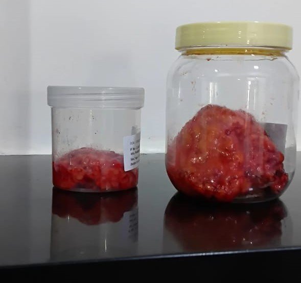 Breast Cancer Treatment