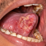 Ayurvedic Mouth Cancer Treatment in Thane