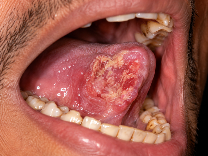Ayurvedic Mouth Cancer Treatment in Thane