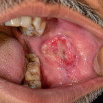 oral cancer treatment
