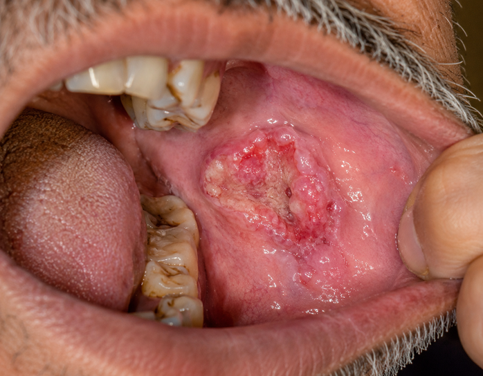 oral cancer treatment