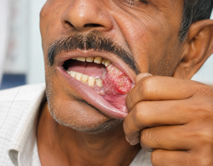 oral cancer in Mumbai