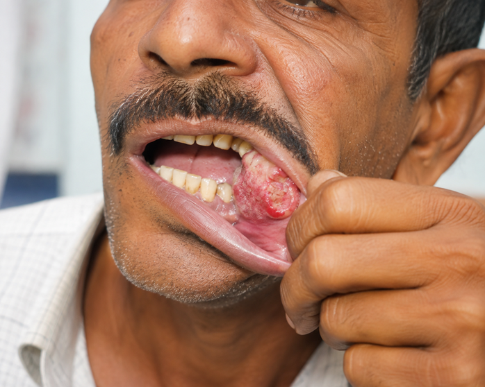 oral cancer in Mumbai