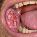 oral cancer in Mumbai