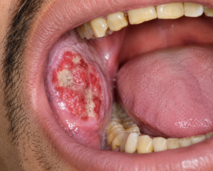 oral cancer in Mumbai