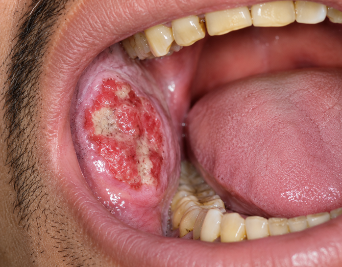 oral cancer in Mumbai