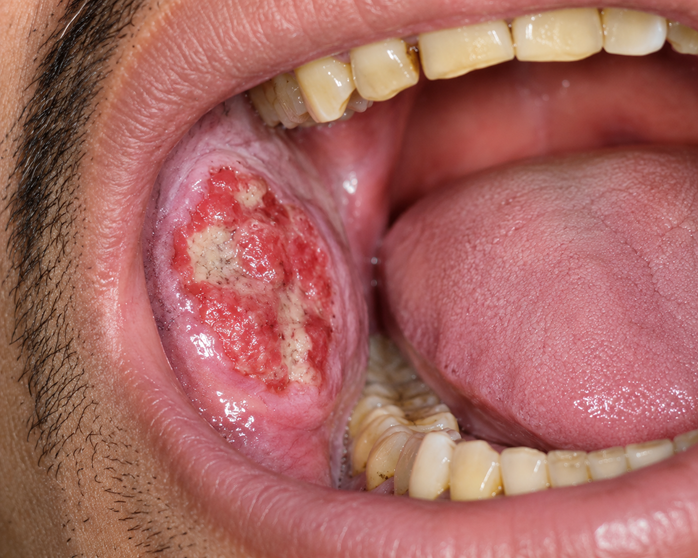 oral cancer in Mumbai