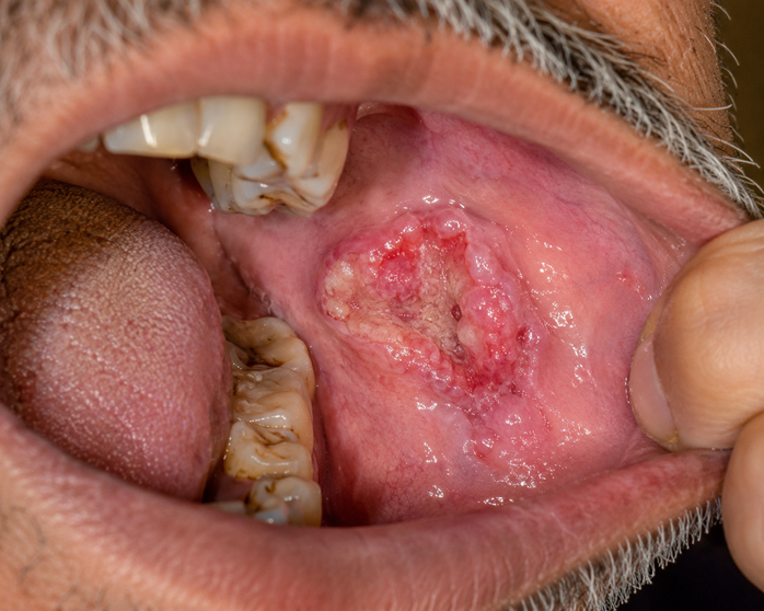 oral cancer treatment
