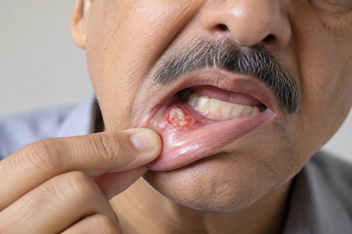Oral Cancer in Gujarat